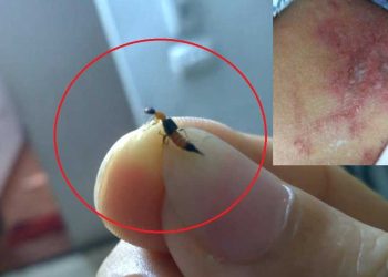 Điều gì xảy ra khi bị kiến ba khoang cắn?