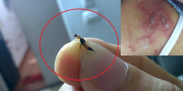 Điều gì xảy ra khi bị kiến ba khoang cắn?