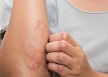 Những sai lầm thường gặp khi xử lý kiến ba khoang cắn