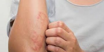 Những sai lầm thường gặp khi xử lý kiến ba khoang cắn