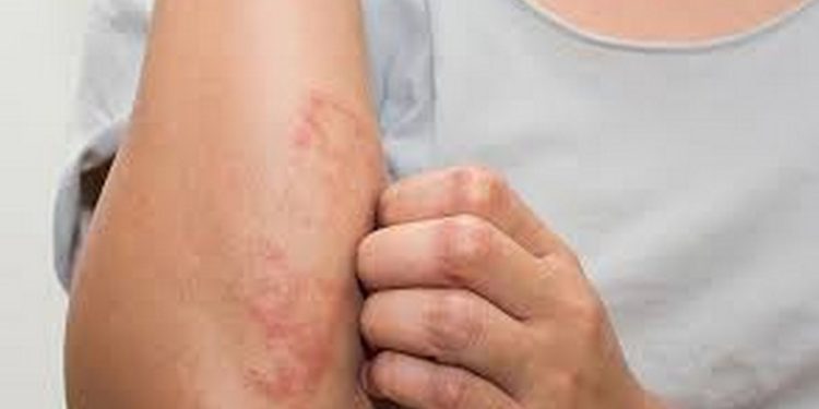 Những sai lầm thường gặp khi xử lý kiến ba khoang cắn