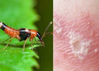 Bị kiến ba khoang cắn bôi thuốc gì?