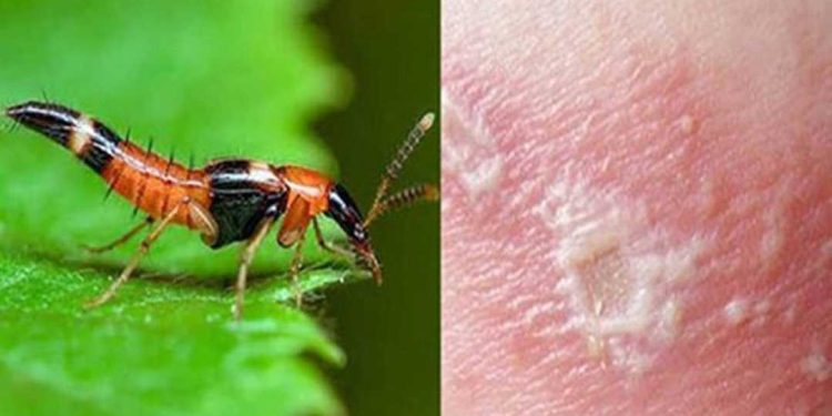 Bị kiến ba khoang cắn bôi thuốc gì?