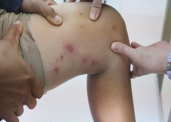 Không nên gãi nếu bị kiến ba khoang cắn