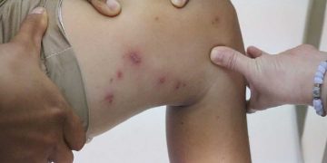 Không nên gãi nếu bị kiến ba khoang cắn