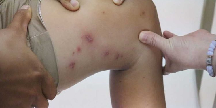 Không nên gãi nếu bị kiến ba khoang cắn