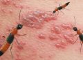 Vết thương khi bị kiến ba khoang cắn