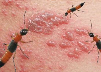 Vết thương khi bị kiến ba khoang cắn