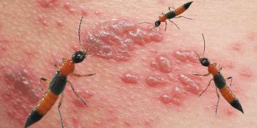 Vết thương khi bị kiến ba khoang cắn